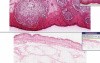 Furuncle (abscess) - Histopathology - Skin