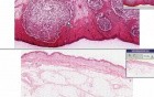 Furuncle (abscess) - Histopathology - Skin