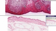 Furuncle (abscess) - Histopathology - Skin