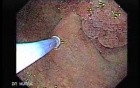Multilobulated Gastric Polyp (5 of 20)