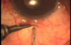 TCTCF technique