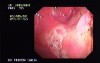 Gastric Cancer