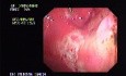Gastric Cancer