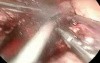 Laparoscopic total gastrectomy enbloc partial hepatectomy for malignant tumor