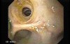 Choledocoduodenostomy and The Sump Syndrome (5 of 10)