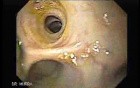 Choledocoduodenostomy and The Sump Syndrome (5 of 10)
