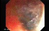 Familial Adenomatous Polyposis (16 of 36)