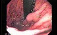 Large Gastric Varices (3 of 4)