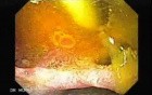 Choledocoduodenostomy (1 of 3)