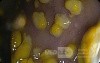 Endoscopic appearance of the Pseudomembranous colitis