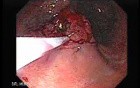 Gastrointestinal Stromal Tumor - GIST (7 of 65)