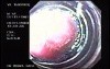Banding of Esophageal Varices - View Through the Banding Apparatus