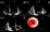 Echocardiograpic Assessment of Mitral Valve Regurgitation - Dobutamine Stress Test