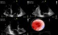 Echocardiograpic Assessment of Mitral Valve Regurgitation - Dobutamine Stress Test