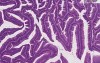Villous adenoma - Histopathology - Colon