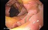 Gastroduodenal MALT lymphoma (4 of 9)