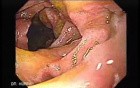 Gastroduodenal MALT lymphoma (4 of 9)