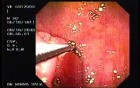 Irregular Ulcer at the Corpus - Biopsy