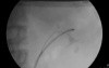 RIRS - Fluoroscopic View