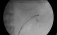 RIRS - Fluoroscopic View