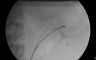 RIRS - Fluoroscopic View