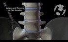 Discectomy and Interbody Fusion