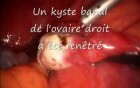 Laparoscopic Ovariectomy Due To Ovarian Cyst