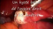 Laparoscopic Ovariectomy Due To Ovarian Cyst