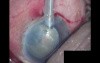Cataract Surgery - Part 1/2