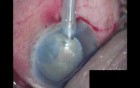 Cataract Surgery - Part 1/2