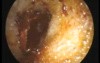 Skull Base Fracture - Mastoid Bruise (Battle Sign)