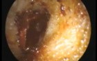 Skull Base Fracture - Mastoid Bruise (Battle Sign)