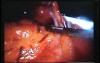 Jejunal Gastrointestinal Stromal tumor (GIST) (28 of 86)