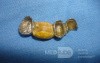 Dental Prothesis Found in the Jejuno (7 of 9)