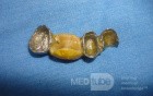 Dental Prothesis Found in the Jejuno (7 of 9)