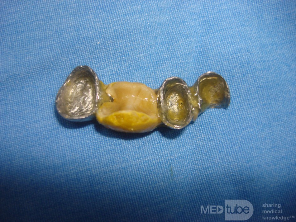 Dental Prothesis Found in the Jejuno (7 of 9)