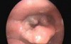 Supraglottic Carcinoma Of Larynx