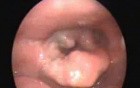 Supraglottic Carcinoma Of Larynx
