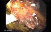 Gastrointestinal Bleeding Caused by Advanced Gastric Carcinoma - Absolute Alcohol Injections