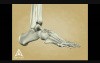 Charkot Foot - 3D Medical Animation