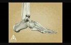 Charkot Foot - 3D Medical Animation