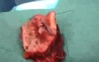 Cervicofacial Advancement Flap - Squamous Cell Carcinoma