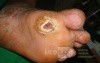 Diabetic foot ulcer - neuropathic -associated with ostemyelitis 