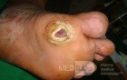 Diabetic foot ulcer - neuropathic -associated with ostemyelitis 