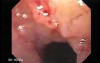 Esophageal Squamous Cell Carcinoma (2 of 2)