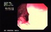 Familial Adenomatous Polyposis of the Colon (3 of 30)