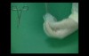 Direct Inguinal Hernia - PHS (Prolene Hernia System)