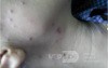 Varicella