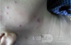 Varicella