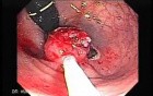 Endoscopic Resection of Giant Tubulo-Villous of the rectum (19 of 35)